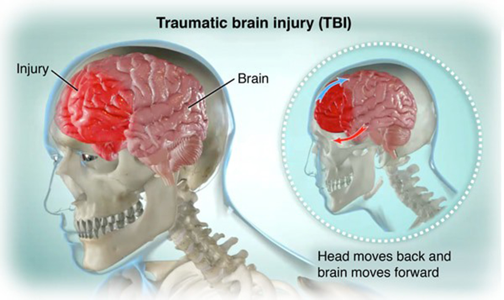 Traumatic Brain Injuries