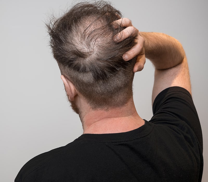 Conditions Treated with Hair Rejuvenation